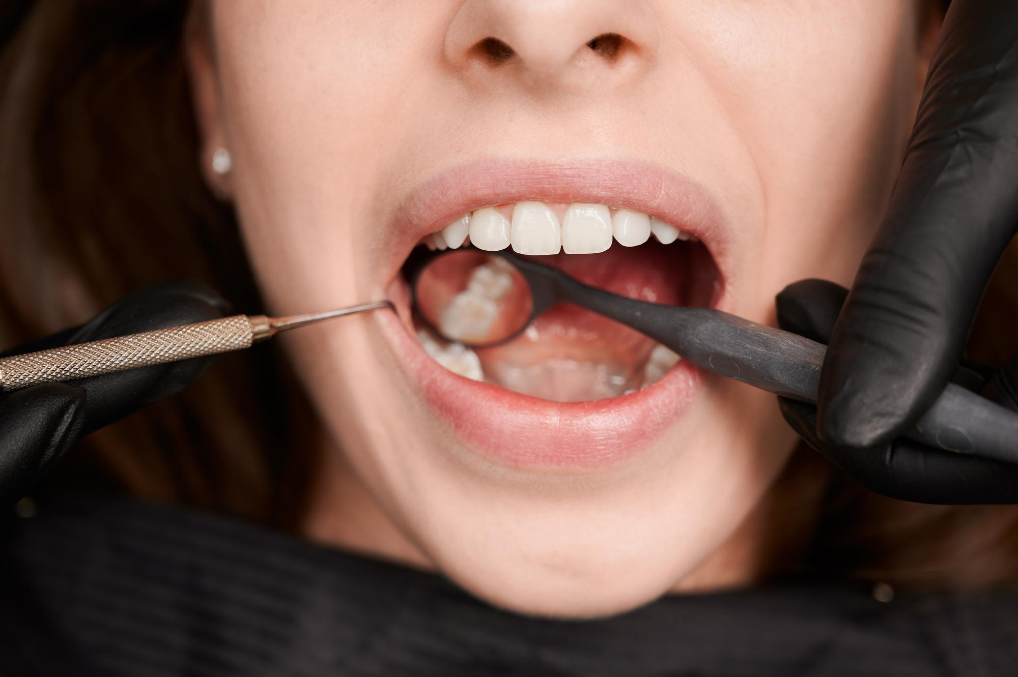 Root Canal Symptoms: Key Warning Signs You Shouldn’t Ignore